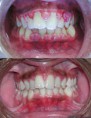 /album/fotogaleria/a220px-gingivitis-before-and-after-2-jpg1/